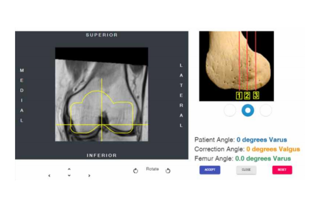 Coronal Femur